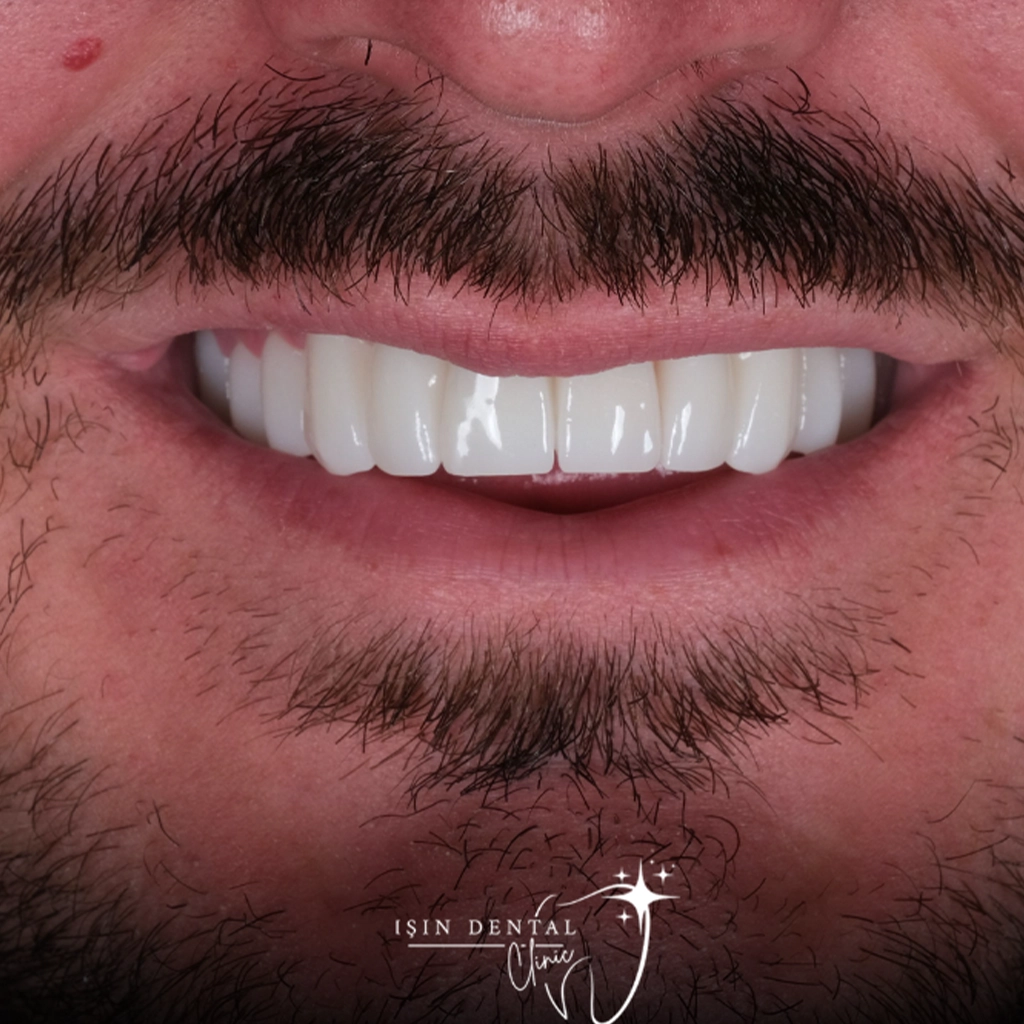 Before and After Treatment 2